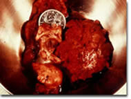 Dilation and Curettage